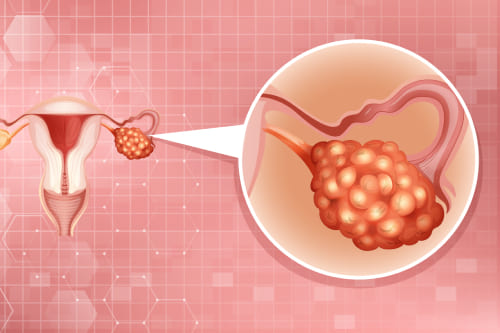Menopausia y detección de cáncer de ovario