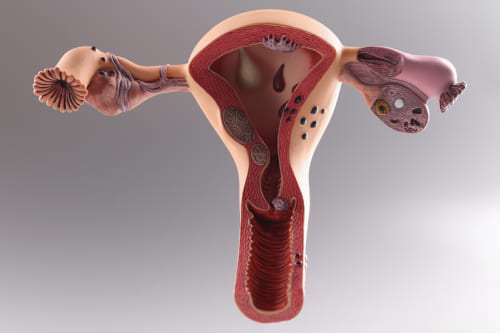 Menopausia y pólipos endometriales