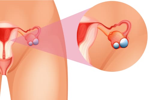 Menopausia y tumores de ovario