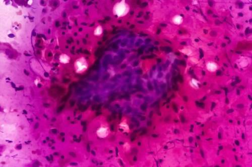 Tratamiento de lesión intraepitelial de alto grado