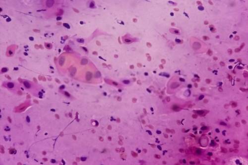 Tratamiento de lesión intraepitelial de bajo grado