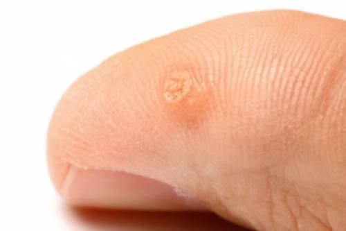 Tratamiento de verrugas vulgares