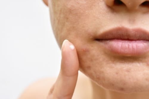 Tratamiento de insensibilidad de andrógenos