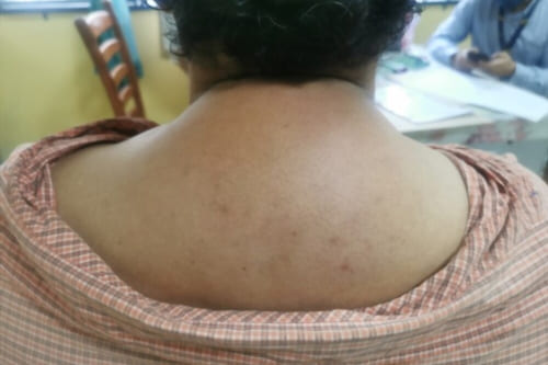 Tratamiento de síndrome de Cushing