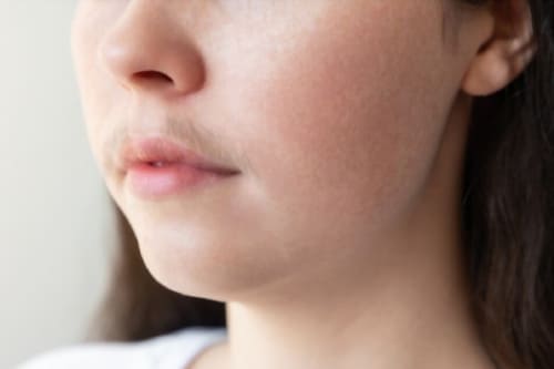 Tratamiento de acné e hirsutismo