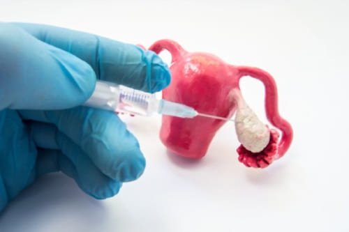 Biopsia de endometrio