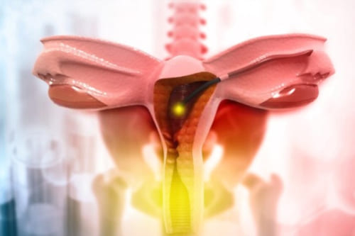 Histerectomía vaginal