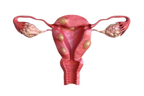 Tratamiento médico (farmacológico) de miomatosis uterina