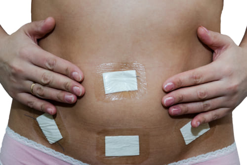 Miomectomía laparoscópica