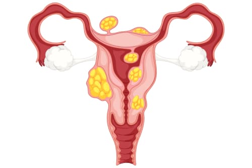 Tratamiento de miomatosis uterina