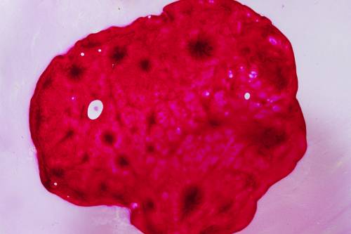 Biopsia de endometrio por histeroscopia