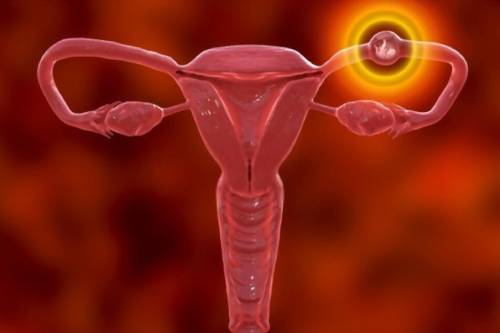 Tratamiento de embarazo ectópico cervical por histeroscopia