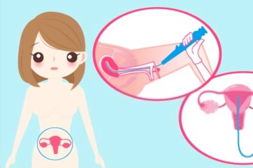 Histeroscopia de consultorio