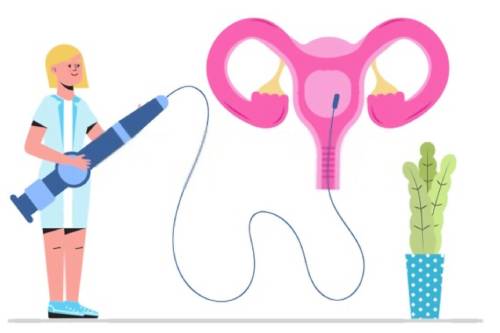 Tratamiento de istmocele por histeroscopia