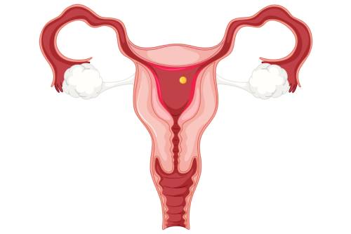 Tratamiento de mioma abortado por histeroscopia
