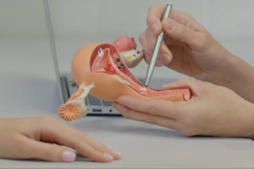 Ablación de ligamentos útero-sacros por laparoscopia