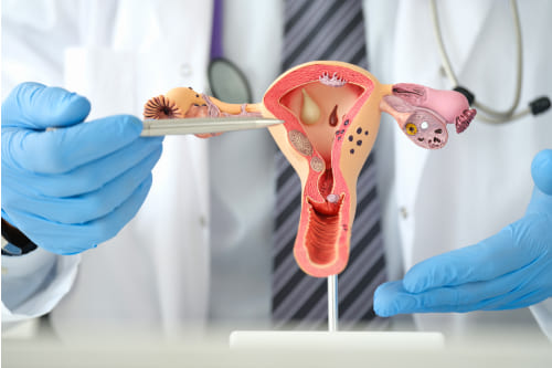 Endometriosis profunda por laparoscopia