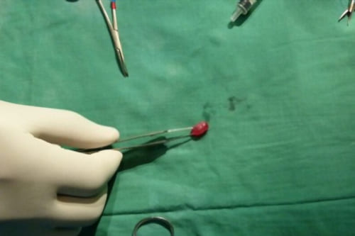 Exceresis de endometriomas por laparoscopia