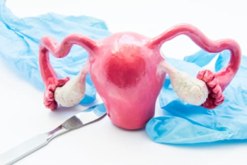 Miomectomía laparoscópica