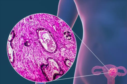 Tratamiento de cáncer de endometrio por laparoscopia
