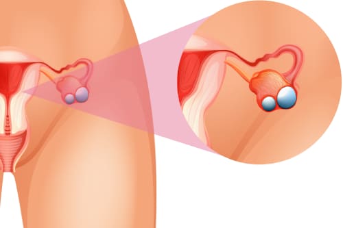 Tratamiento de tumores gigantes de ovario por laparoscopia