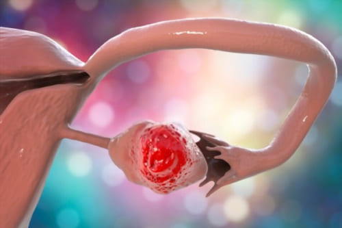 Exceresis de tumores de ovario por laparoscopia