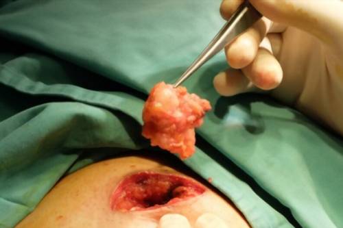 Tratamiento de fibroadenomas