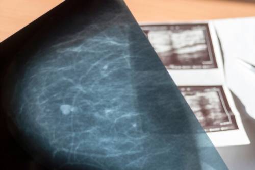 Tratamiento de quistes mamarios