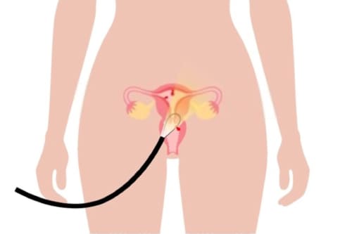 Legrado uterino instrumentado