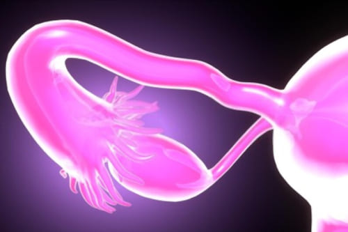 Tratamiento de infertilidad por causa tubárica