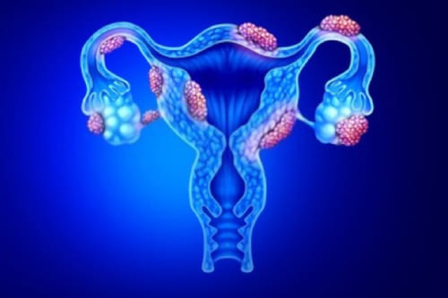 Tratamiento de infertilidad por endometriosis